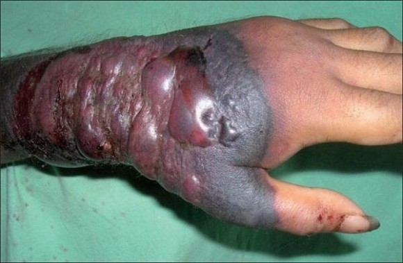 Một bàn tay bị hoại tử sau khi nhiễm virus Ebola.