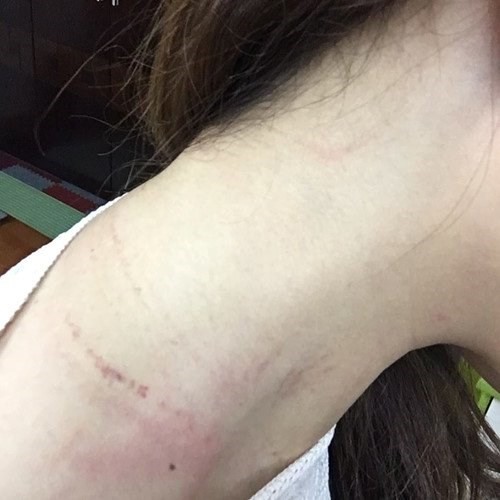 Trên cổ của chị Nguyễn Lê Quỳnh Anh xuất hiện những vết trầy xước sau khi bị lôi kéo, hành hung. ảnh chụp từ clip.