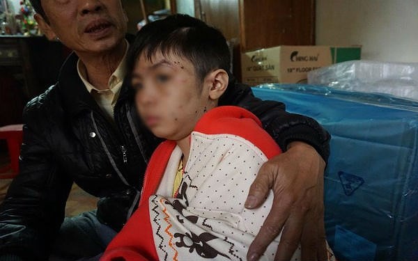 Bé trai 10 tuổi tại Hà Nội bị bố và mẹ kế bạo hành. ảnh: vov.