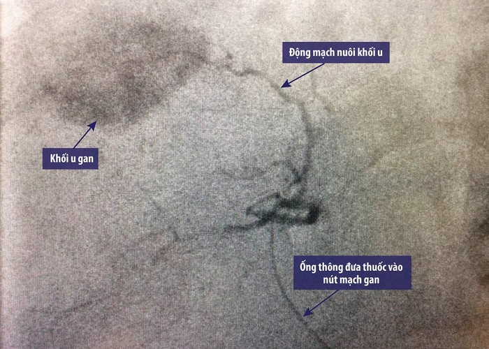 Hình ảnh khối u gan được bơm thuốc nút mạch dưới hướng dẫn DSA.