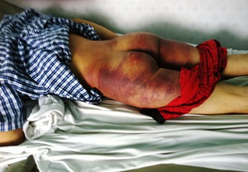 Vết thương trên phần mông và đùi của Thắng. (Ảnh chụp tại BV Đa khoa tỉnh Bình Dương ngày 13-9)