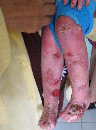 Ghép tủy cứu bé 4 tuổi bị "lột da ếch" ảnh 1