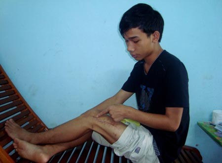 Vết thương ở chân em Hiếu ngày càng đau nhức, khiến việc sinh hoạt vô cùng khó khăn.