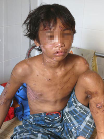 Hào Anh đầy thương tích khi được người dân cứu khỏi trại tôm giống Minh Đức vào tháng 5.2010. Ảnh: TTX.