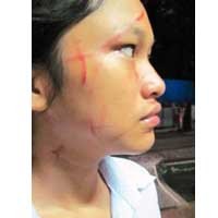 Nữ sinh Châu bị nhiều vết rách trên má do bị bà Lê Thu Hương hành hung