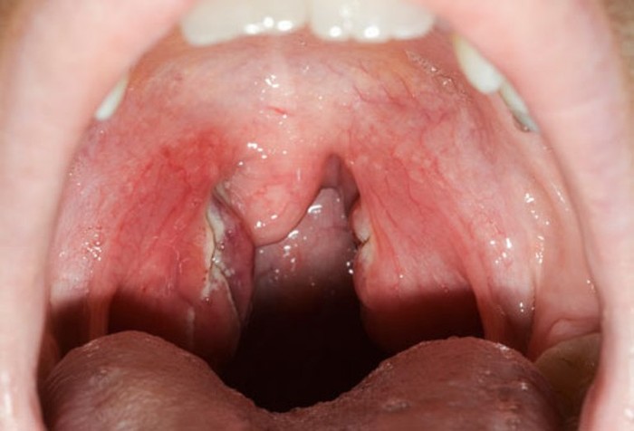 16. Viêm họng: Những dấu hiệu bao gồm đau họng kéo dài hơn một tuần, đau đớn hoặc khó nuốt, chảy nước dãi quá mức, phát ban, có mủ ở mặt sau của cổ họng … Viêm họng được điều trị bằng kháng sinh.