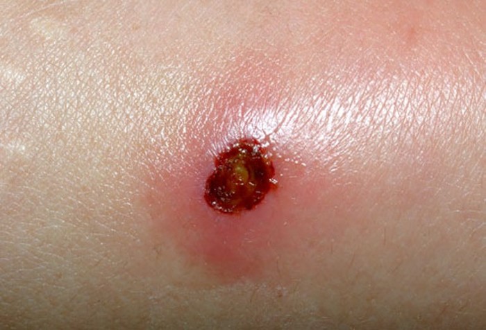 19. Nhiễm trùng da: Bệnh do loại vi khuẩn có tên là MRSA gây nên. Bệnh nhiễm trùng này thường xuất hiện ở các vết loét hoặc bóng nước.