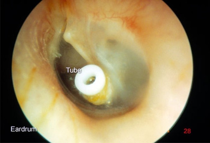 3. Keo tai: Đây là sự tích tụ của chất lỏng trong tai giữa (có hoặc không có bất kỳ sự đau đớn nào) được gọi là viêm tai giữa (OME). Bệnh thường xảy ra khi đã bị nhiễm trùng tai hoặc nhiễm trùng đường hô hấp. Căn bệnh này có thể ảnh hưởng đến thính giác của đứa trẻ.