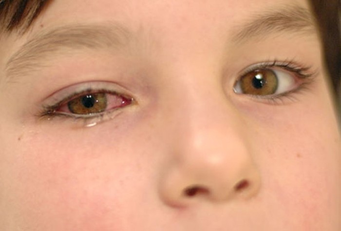 6. Bệnh đau mắt đỏ: Bệnh do một loại virus cảm lạnh thông thường gây nên. Bệnh đau mắt đỏ lây lan nhanh trong các trường học và các trung tâm chăm sóc trẻ em. Bệnh có thể trở thành đại dịch.