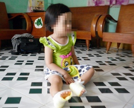 Một bé gái 3 tuổi bị bỏng cả hai gan bàn chân vì bị cô bảo mẫu phạt đứng ở sân trường giữa trời nắng nóng. Sự việc xảy ra tại Trường mẫu giáo tư thục măng non Mỹ Hải (phường Mỹ Hải, TP.Phan Rang - Tháp Chàm) hồi cuối tháng 6.2013 - Ảnh: Thiện Nhân