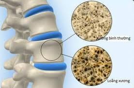 Canxi là một yếu tố cần thiết cho xương, thiếu canxi gây ảnh hưởng nặng nề lên xương.