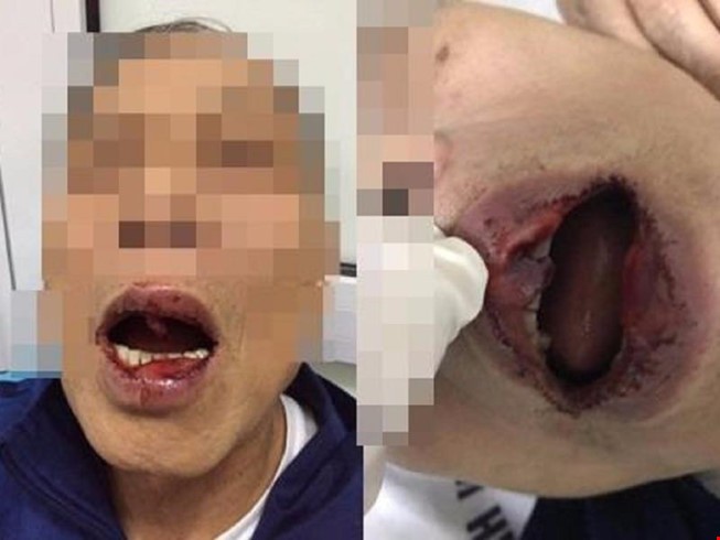 Tiến sĩ Khanh bị hành hung với thương tích quanh miệng (ảnh đăng trên Báo Pháp luật TP.HCM).