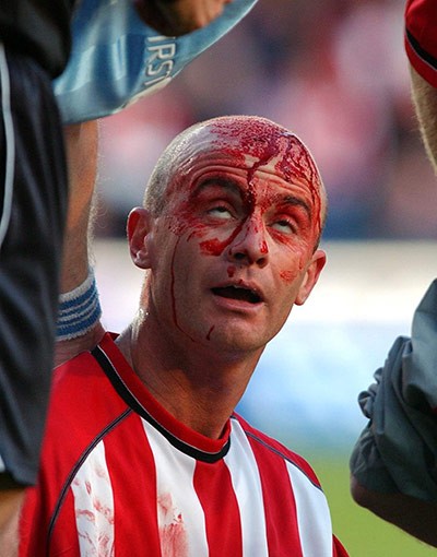 Máu chảy đầm đìa trên đầu và mặt Chris Marsden (Southampton) sau khi va chạm mạnh với Sun Jihai (Manchester City) trong trận đấu trên sân (St Mary) ngày 1/11/2003.