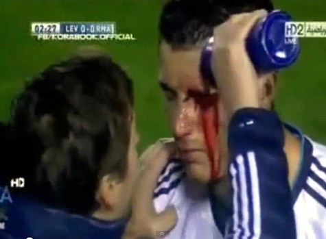 Ronaldo mất nhiều máu vì chấn thương này.