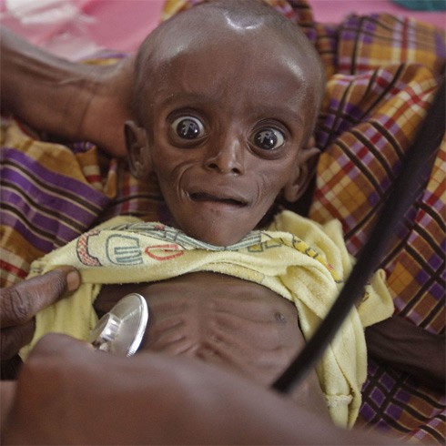 Cặp mắt và thân hình gày gò của Mihag Gedi Farah, 7 tháng tuổi và đang được các bác sĩ khám tại Dadaab (Kenya), đã ám ảnh rất nhiều người. Ảnh: AP.