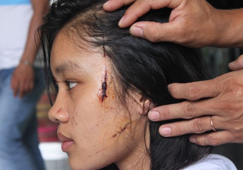 Những vết thương trên gương mặt của nữ sinh Trần Nữ Diễm Trinh - Ảnh: Văn Kỳ