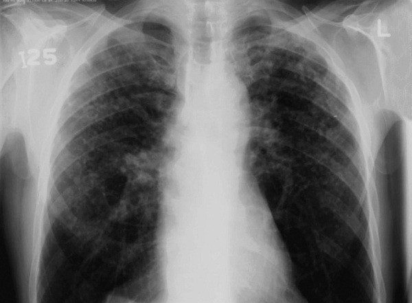 Bức ảnh X-quang chụp phổi một thợ mỏ được chẩn đoán là ung thư phổi do hít phải quá nhiều các tinh thể bụi silic tự do có trong cát, vàng, kim loại… (Ảnh: NIOH / NHLS).