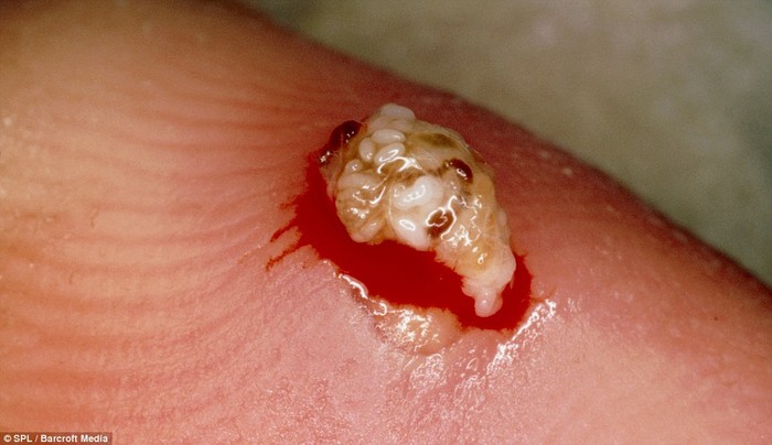 Đây là con rệp kẽ ngón tay và trứng của nó. Loài rệp này chuyên luồn dưới da để hút máu