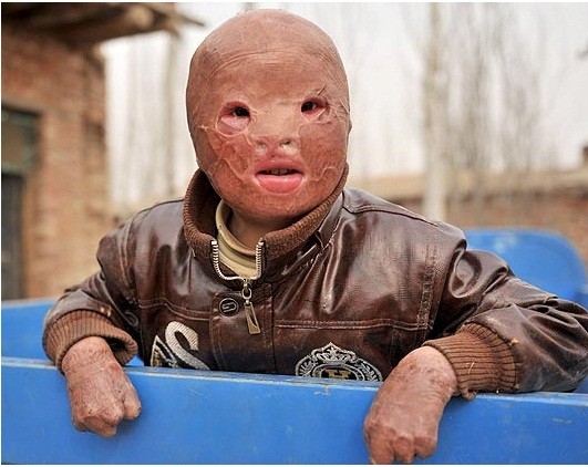 Mới 6 tuổi, Wang Xiaopeng đã phải sống sau lớp mặt nạ của những vết sẹo.