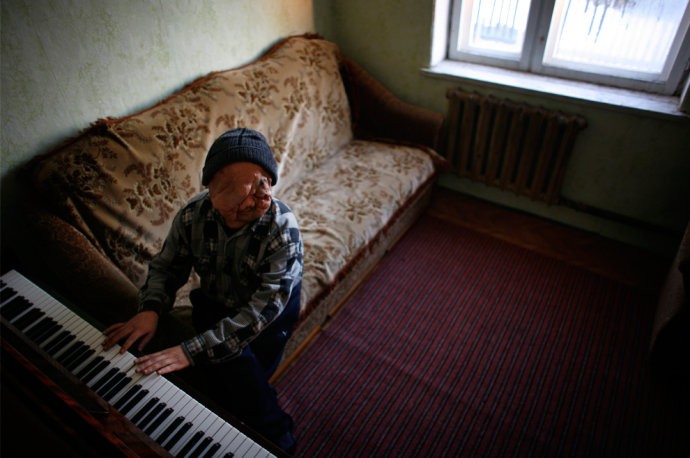 Berik, 29 tuổi, chơi đàn piano và hát trong ngôi nhà của mình. Trong thời gian tới Ý làm phẫu thuật mặt anh đã học chơi đàn piano và thích hát opera.