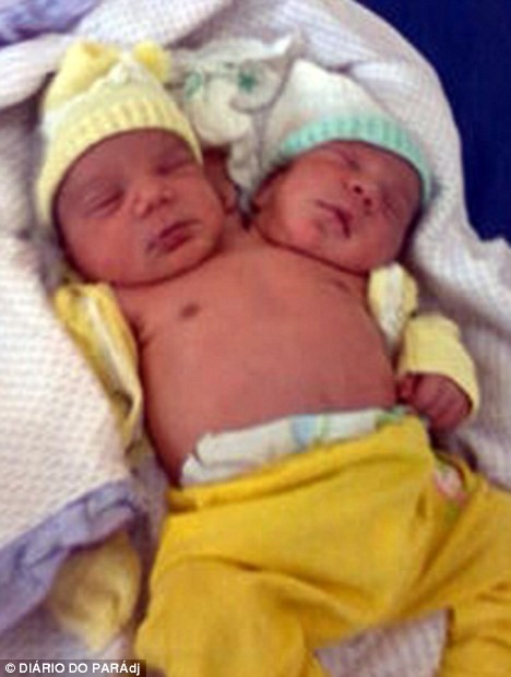 Em bé sơ sinh 2 đầu vừa chào đời tại Brazil