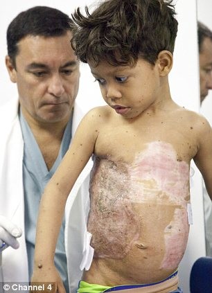 Bác sĩ Bulstrode kiểm tra tình trạng sức khỏe của cậu bé "mai rùa" sau ca phẫu thuật cắt bỏ nốt ruồi và ghép da phức tạp.