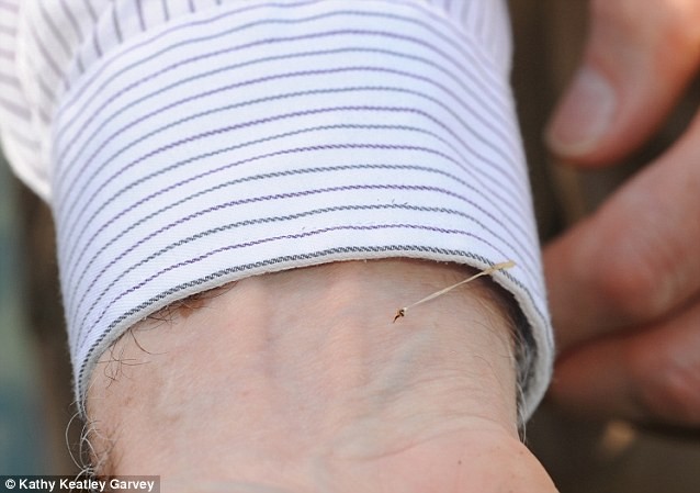 Con ong để lại ngòi châm và mô bụng trên tay nạn nhân.