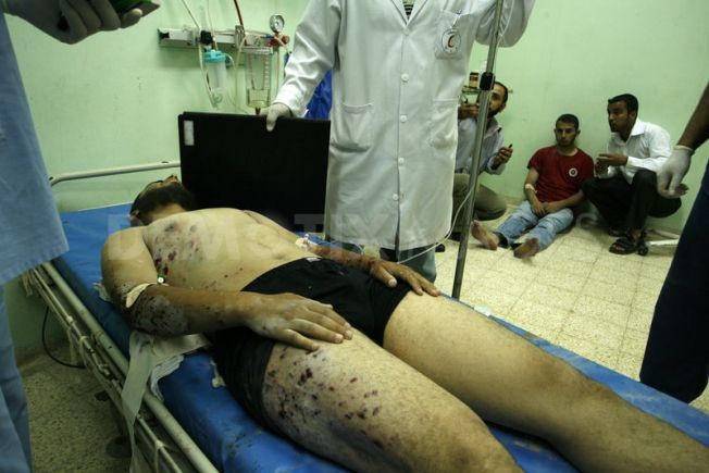 Các vết thương trên mình người đàn ông Palestine.