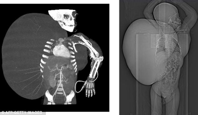 Ảnh chụp X-quang cho thấy khối u nặng 15 kg phát triển trên cơ thể cậu bé Jesus, 2 tuổi, nặng 11 kg (không kể khối u).