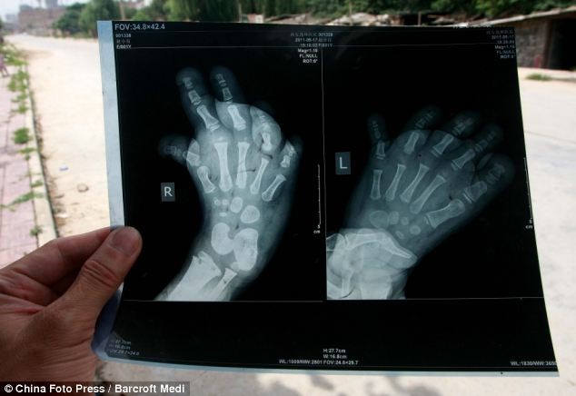 Ảnh chụp X-quang cho thấy xương bàn chân của Ngọc đã bị biến dạng và có xu hướng cong lên.