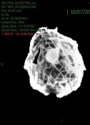 Ảnh MRI cho thấy con hàu cổ đại chứa bên trong một viên ngọc có kích cỡ bằng quả bóng golf.
