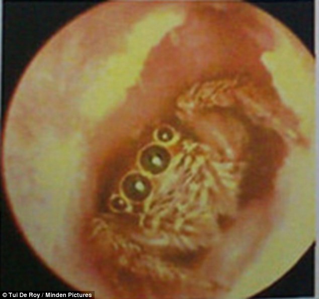 Con nhện ẩn náu trong tai nữ bệnh nhân Trung Quốc.