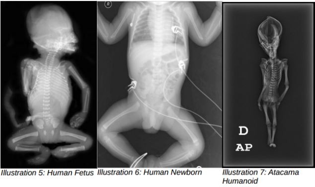 Một so sánh phim x-quang cho thấy một sự khác biệt đáng kể giữa sự phát triển xương của thai nhi con người và của Ata.