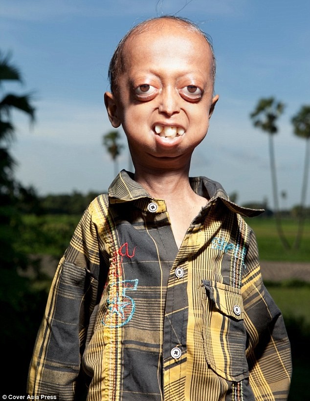 Ali Hussain là người thứ 6 trong gia đình mắc chứng bệnh di truyền được gọi là Progeria.