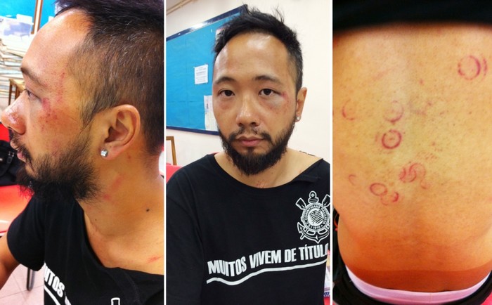 Tsang và những vết thương trên cơ thể sau khi bị cảnh sát đánh đập.