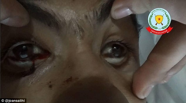 Một người Kurd bị tổn thương mắt sau vụ tấn công hóa học của IS tại Kobani.
