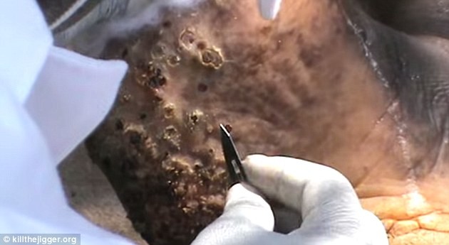 Các nhân viên y tế loại bỏ bọ chét cát từ bàn chân của một người đàn ông đã bị chúng làm tổ nhiều năm.