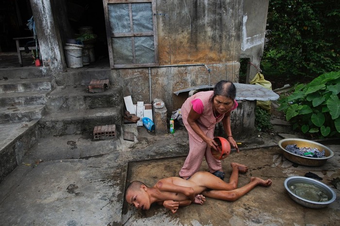 Hiệp hội nạn nhân chất độc da cam/dioxin Việt Nam cho biết, hơn 4,8 triệu người Việt Nam đã tiếp xúc với thuốc diệt cỏ trong chiến tranh và hơn 3 triệu người nhiễm chất độc chết người này.