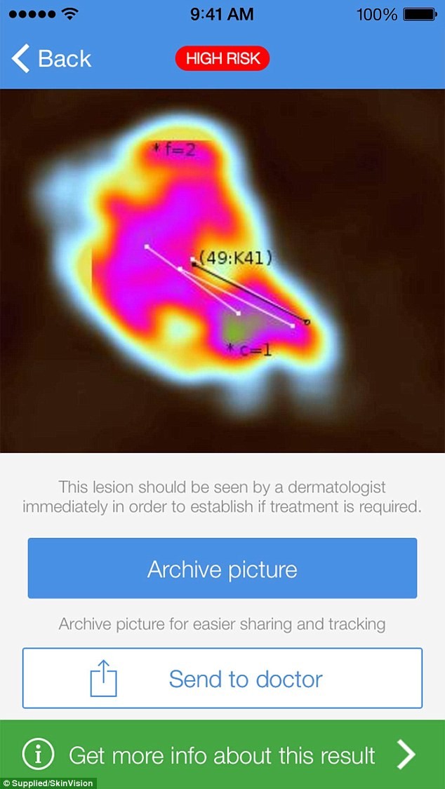 Phần mềm cho ra kết quả phân tích tổn thương trên da và đánh giá nguy cơ ung thư da cao hoặc thấp, đề xuất chia sẻ dữ liệu tới bác sĩ của người sử dụng.