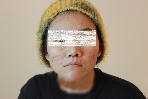 Khuôn mặt đầy sẹo và mụn của ca sĩ Anh Thúy sau khi gặp phải tai nạn xe, hiện cô đang được chữa trị tại một thẩm mĩ viện.