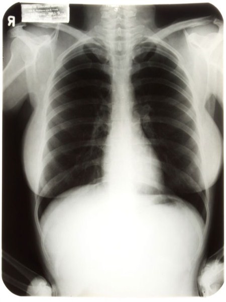 Ảnh chụp X quang ngực của Marilyn Monre tại một bệnh viện năm 1954 được bán với giá 45.000 USD vào tháng 6/2010.