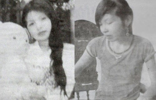 Nguyễn Thị Tuyến trước (ảnh trái) và sau khi mắc căn bệnh kỳ lạ
