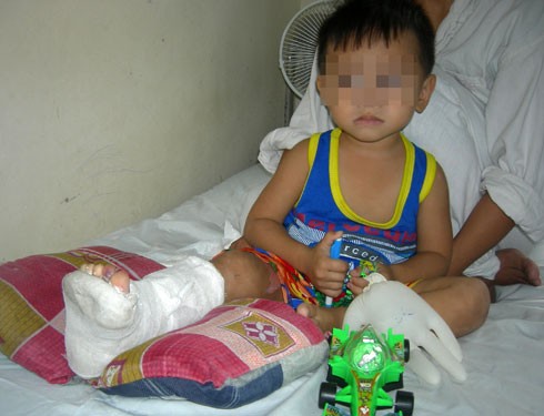 Vì nghĩ không nối nên được nên bàn chân của cậu bé 3 tuổi ở Thái Bình này từng bị vứt xuống sông. Ảnh: N.P.