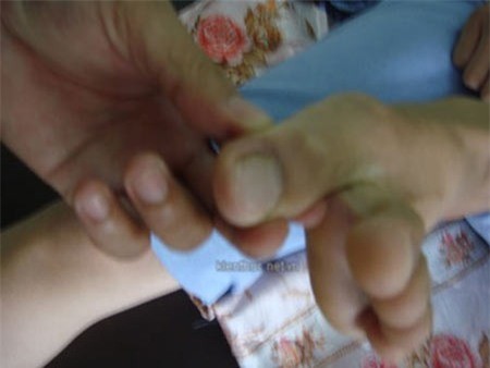 Vết chuột cắn trên ngón chân cái trái của bệnh nhân