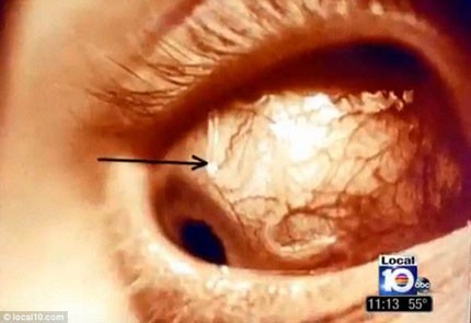Ashley Hyde, 18 tuổi đến từ Pembroke Pines, Florida, Mỹ đã suýt phải bỏ đi mắt trái sau khi bị một loại kí sinh trùng phát triển trên kính áp tròng chui vào mắt qua giác mạc.