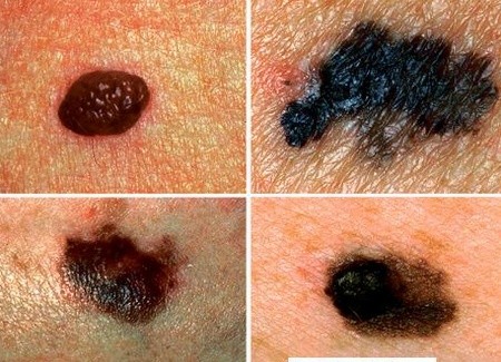 Ung thư da là bệnh phổ biến và có thể chữa được nếu phát hiện sớm.