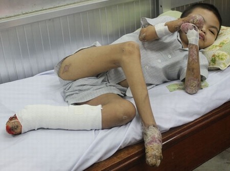Bệnh nhân 18 tuổi bị rụng tay chân được xác định mắc hội chứng Vohwinkel hiếm gặp trên thế giới.