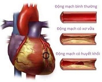Một số tổn thương mạch máu tim.