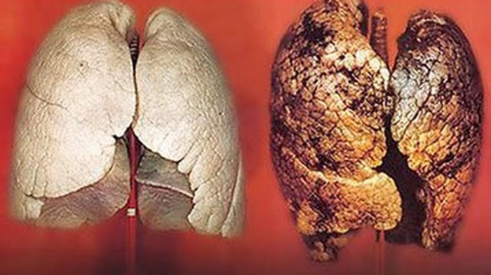 Ung thư phổi và gan được đánh giá là 2 trong 10 loại ung thư phổ biến nhất khu vực Đông Nam Á cũng như tại Việt Nam. Ảnh minh họa, nguồn: Internet.