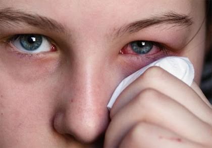 Theo Cục Y tế dự phòng, Bộ Y tế nguyên nhân chủ yếu của bệnh đau mắt đỏ là do vi rút Adenovirus, hoặc do vi khuẩn như liên cầu, tụ cầu, phế cầu gây ra. Ảnh minh họa, nguồn: Internet.